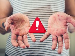 El Comité Nacional para la Vigilancia Epidemiológica emitió un aviso epidemiológico, para promover que el personal de salud a detecte y notifique los casos probables de sarampión o rubéola. ESPECIAL / CANVA