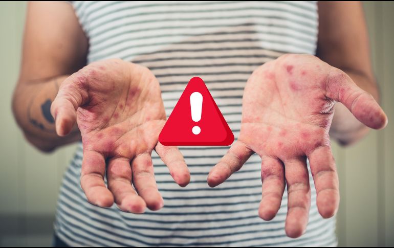 El Comité Nacional para la Vigilancia Epidemiológica emitió un aviso epidemiológico, para promover que el personal de salud a detecte y notifique los casos probables de sarampión o rubéola. ESPECIAL / CANVA