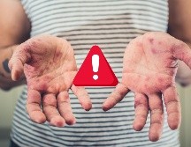 El secretario de Salud en Jalisco, Héctor Raúl Pérez Gómez, informó que 39 de los casos se registraron en el municipio de Arandas. ESPECIAL