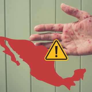 Estos son los 18 estados de México que registran casos de sarampión
