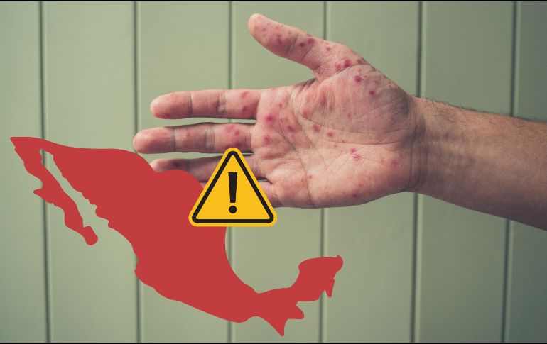 El nuevo brote de sarampión a nivel nacional sigue en aumento. Hasta este martes 30 de septiembre en todo el país se tenían registrados 4 mil 758 casos en total y 21 defunciones de acuerdo con datos de la Secretaría de Salud. ESPECIAL