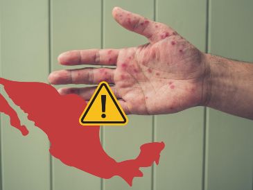 El nuevo brote de sarampión a nivel nacional sigue en aumento. Hasta este martes 30 de septiembre en todo el país se tenían registrados 4 mil 758 casos en total y 21 defunciones de acuerdo con datos de la Secretaría de Salud. ESPECIAL