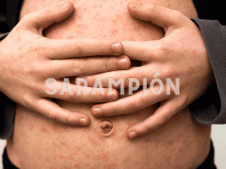 La tarde de este miércoles se confirmó otra muerte más por sarampión en el estado de Chihuahua. ESPECIAL / CANVA