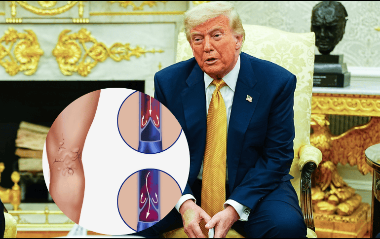 La insuficiencia venosa crónica (IVC) ocurre cuando las venas de las piernas se dañan y no pueden funcionar correctamente. EFE/A. SCHWARTZ / ESPECIAL / FEDERACIÓN MEXICANA DE DIABETES