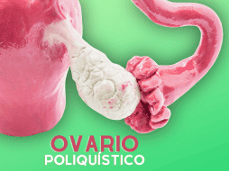 Dentro de los elementos centrales para el desarrollo de ovario poliquístico está la resistencia a la insulina. ESPECIAL / CANVA