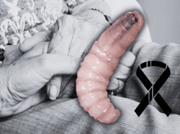 Por la infección de gusano barrenador, la adulta mayor recibió tratamiento. ESPECIAL