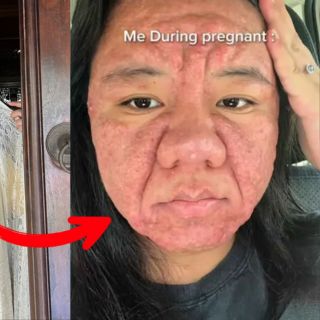 Mujer sufre cambio extremo en su rostro debido a las hormonas del embarazo