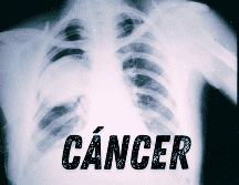 Los pacientes exfumadores tenían un 60% más de riesgo de desarrollar una segunda neoplasia y los que seguían fumando también mostraron un incremento de riesgo 