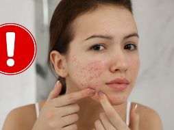 Aunque para muchos pueda parecer exagerado, la recomendación médica es clara: no manipular las lesiones cutáneas en la zona que conecta directamente con el cerebro. CANVA