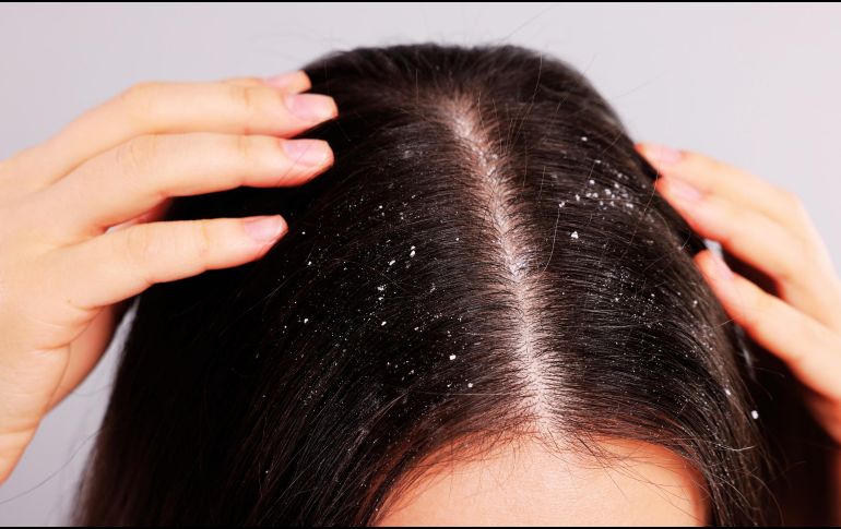Aunque no existe una cura definitiva, el tratamiento adecuado puede mantener los síntomas bajo control y mejorar la salud del cuero cabelludo. ESPECIAL / CANVA