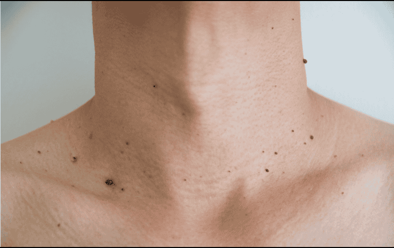 Las verrugas en el cuello son frecuentes y, aunque en la mayoría de los casos no representan un peligro, pueden generar molestias físicas y emocionales. CANVA