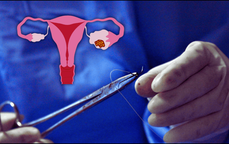 El IMSS en Querétaro tiene un registro de 13 casos de cáncer de ovario durante 2024, la mayoría a mujeres entre 25 y 65 años de edad; en lo que va del año se tiene un registro de tres casos. ESPECIAL / CANVA