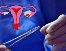 El IMSS en Querétaro tiene un registro de 13 casos de cáncer de ovario durante 2024, la mayoría a mujeres entre 25 y 65 años de edad; en lo que va del año se tiene un registro de tres casos. ESPECIAL / CANVA