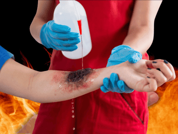 Las quemaduras de segundo y tercer grado no son solo lesiones superficiales: su profundidad y extensión pueden desencadenar una serie de complicaciones críticas que amenazan la vida.  CANVA