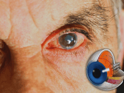 El glaucoma puede incapacitar a las personas, especialmente a los adultos mayores, quienes progresivamente pierden la visión hasta llegar a la ceguera. ESPECIAL / CANVA