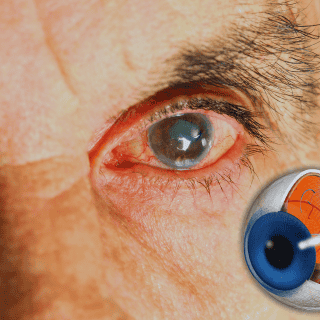 ¿Qué es el glaucoma y cómo afecta a los mexicanos?