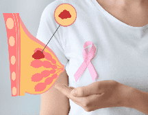 Es posible que el cáncer de mama no cause síntomas en un inicio o que el bulto sea tan pequeño que no pueda ser palpable. ESPECIAL / CANVA