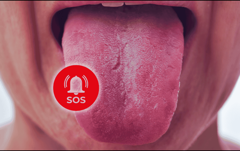 Un paciente con una lesión como úlcera, afta, bulto o cambios en la cavidad oral a un color rojo o blanquecino, que no cede con medicamentos por una semana, debe ser evaluado por un especialista. ESPECIAL / CANVA