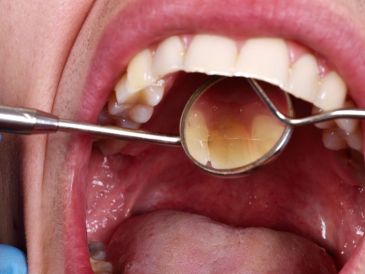 Un control efectivo de la glucosa no solo ayuda a prevenir complicaciones sistémicas, sino también a proteger dientes y encías. CANVA