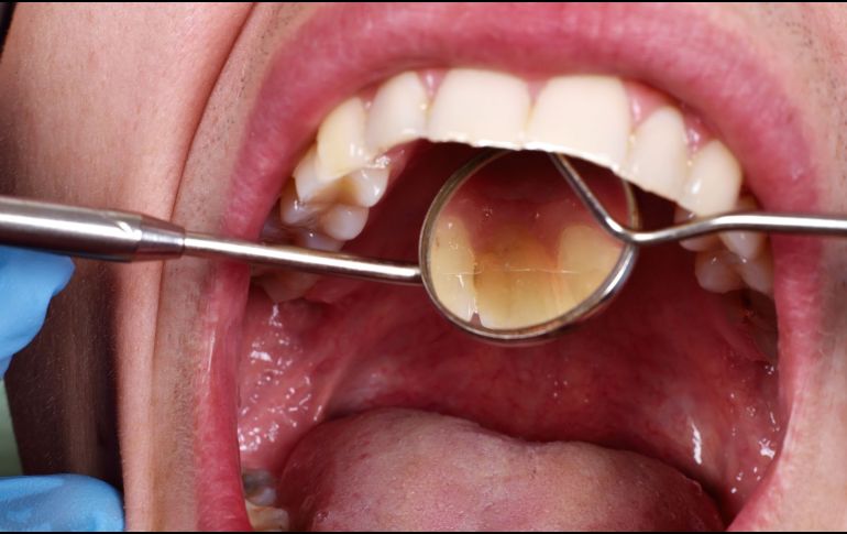 Un control efectivo de la glucosa no solo ayuda a prevenir complicaciones sistémicas, sino también a proteger dientes y encías. CANVA