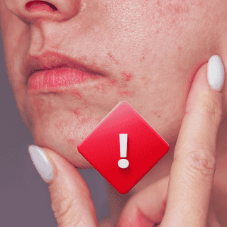 La afección en la piel de las mujeres que se confunde con acné