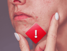 ¿Por qué sale la dermatitis perioral? No hay una causa clara, de hecho, es un conjunto de factores hormonales, predisposición genética e incluso factores ambientales. ESPECIAL / CANVA