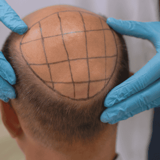 ¿Cuál es la mejor clínica de injerto capilar en México?