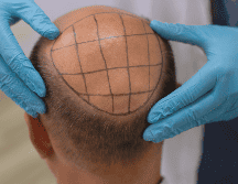 Otra de las razones que aúpan a esta clínica de injerto de cabello como la mejor del país, radica en la figura de su director. ESPECIAL