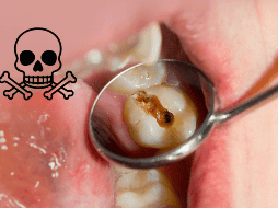 Existen factores que incrementan el riesgo de estas complicaciones, como la falta de atención odontológica, sistemas inmunológicos debilitados, enfermedades crónicas como la diabetes y el uso prolongado de ciertos medicamentos. CANVA