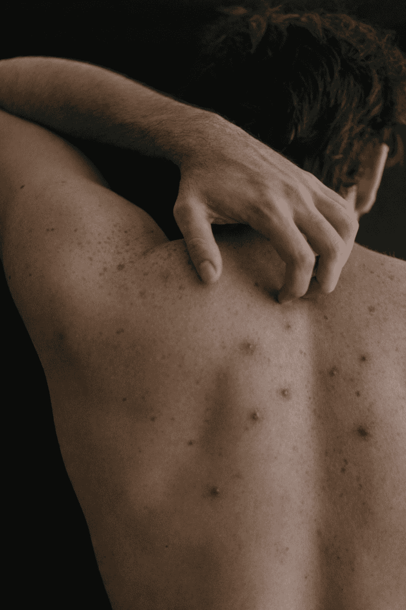  La picadura de chinche pueda causar molestias físicas evidentes como comezón, enrojecimiento e inflamación. UNSPLASH / D. FANUEL&nbsp;