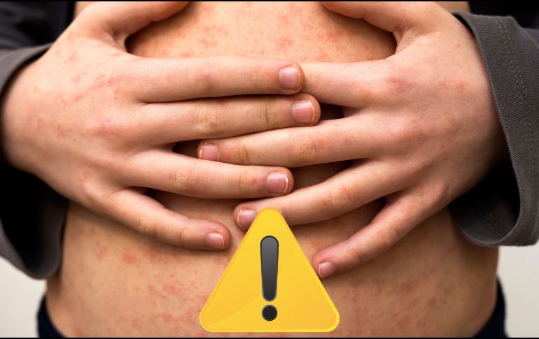 La Dirección General de Epidemiología apuntó que los casos graves son frecuentes en niños pequeños con malnutrición, y sobre todo en los que su sistema inmunitario está debilitado. ESPECIAL / CANVA