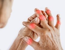 También llamada osteoartrosis es una condición que se agrava durante la temporada de frío y afecta de manera desproporcionada a las mujeres. ESPECIAL / CANVA