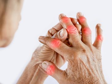 También llamada osteoartrosis es una condición que se agrava durante la temporada de frío y afecta de manera desproporcionada a las mujeres. ESPECIAL / CANVA