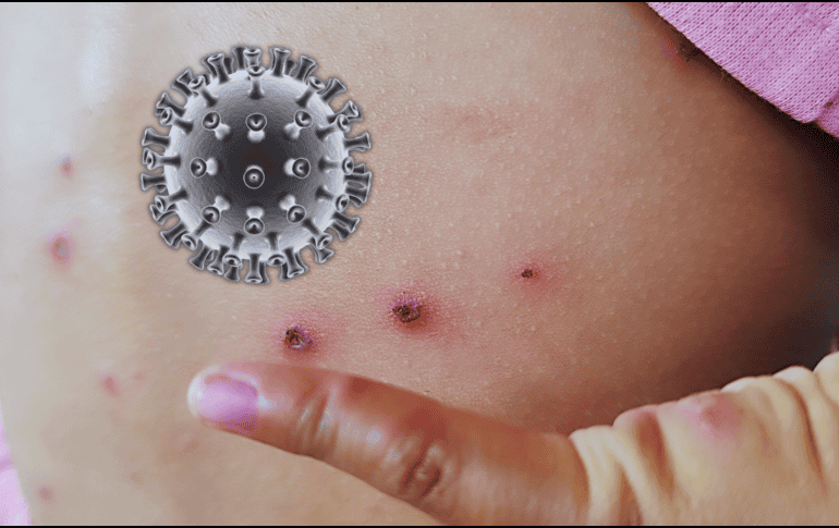 Hasta ahora, en Jalisco, solo una bebé de dos meses proveniente de Guerrero ha fallecido a causa de esta enfermedad. ESPECIAL / CANVA