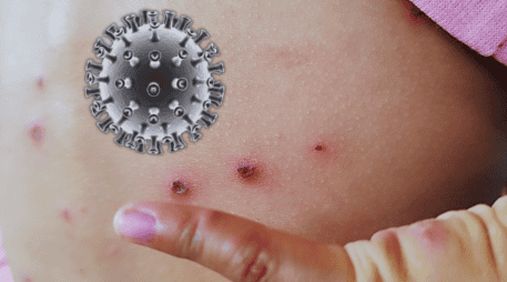 Hasta ahora, en Jalisco, sólo una bebé de dos meses proveniente de Guerrero ha fallecido en el estado a causa de esta enfermedad. ESPECIAL / CANVA