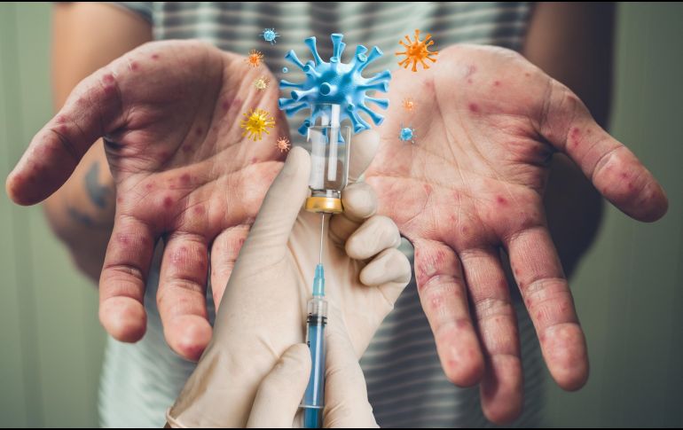 La vacunación contra el sarampión es la principal medida de prevención. ESPECIAL / CANVA