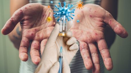 La vacunación contra el sarampión es la principal medida de prevención. ESPECIAL / CANVA