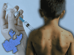 El sarampión causa un sarpullido con manchas rojas, que suele aparecer primero en la cara y detrás de las orejas, para después extenderse al pecho, la espalda y, finalmente, hasta los pies. ESPECIAL