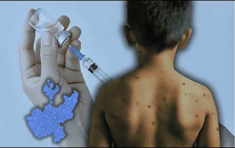 El sarampión causa un sarpullido con manchas rojas, que suele aparecer primero en la cara y detrás de las orejas, para después extenderse al pecho, la espalda y, finalmente, hasta los pies. ESPECIAL