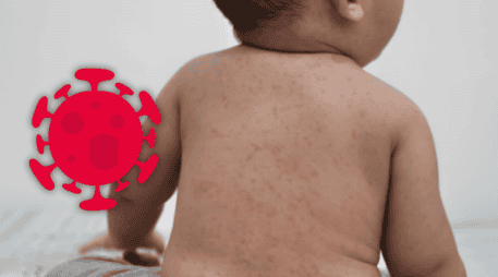 El sarampión es una enfermedad viral que puede iniciar con manifestaciones generales y evolucionar rápidamente. ESPECIAL / CANVA