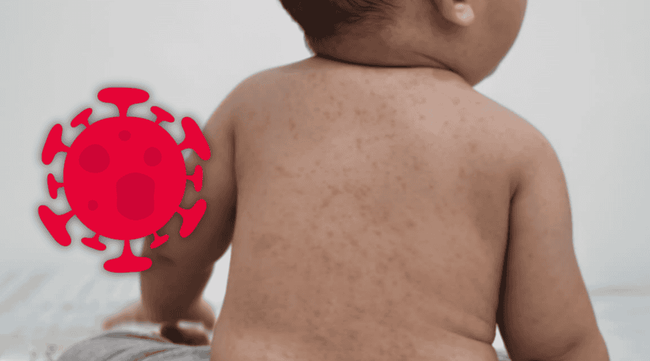 El sarampión es una enfermedad viral que puede iniciar con manifestaciones generales y evolucionar rápidamente. ESPECIAL / CANVA