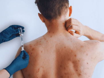 Se estima que una persona con el virus puede propagarlo durante 14 días y contagiar de sarampión hasta 18 personas; piden vacunarse. ESPECIAL / CANVA