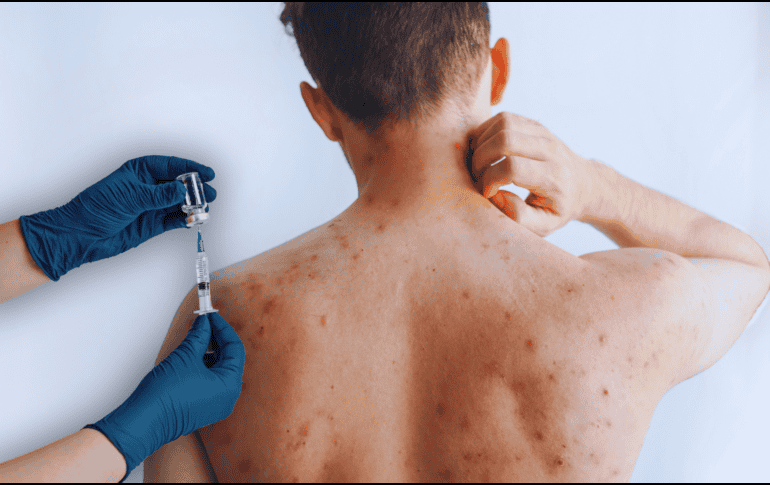 Se estima que una persona con el virus puede propagarlo durante 14 días y contagiar de sarampión hasta 18 personas; piden vacunarse. ESPECIAL / CANVA