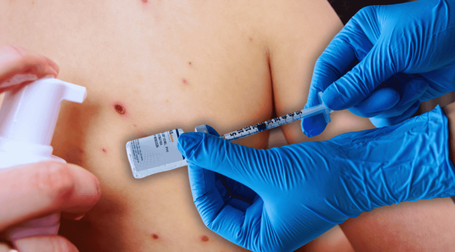 Jalisco ocupa el primer lugar nacional en lo que va del presente año en casos confirmados acumulados de sarampión, con 718. ESPECIAL / CANVA