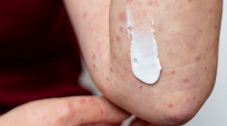 La mayoría de los casos se concentran en el Área Metropolitana de Guadalajara. FREEPIK