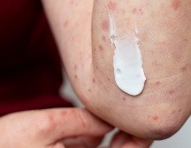 La mayoría de los casos se concentran en el Área Metropolitana de Guadalajara. FREEPIK