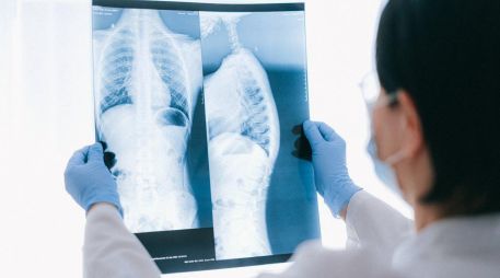 Se trata de Amivantab y Lazertinib, combinación de medicamentos ya disponible en México, que podría ser utilizado por la gran mayoría de pacientes con este tipo de cáncer como sustituto a la quimioterapia. Pexels