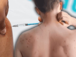 El sarampión es una enfermedad viral altamente contagiosa que no cuenta con un tratamiento específico para eliminar el virus, por lo que la atención médica se centra en aliviar los síntomas y evitar complicaciones. EL INFORMADOR / ESPECIAL