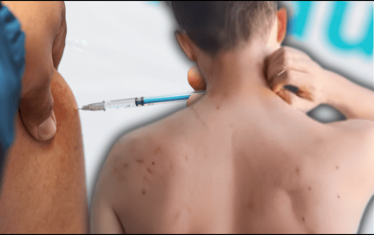 El sarampión es una enfermedad viral altamente contagiosa que no cuenta con un tratamiento específico para eliminar el virus, por lo que la atención médica se centra en aliviar los síntomas y evitar complicaciones. EL INFORMADOR / ESPECIAL