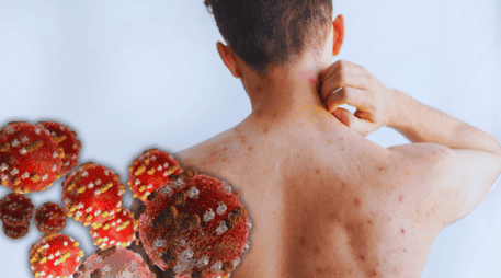 Los síntomas del sarampión pueden aparecer entre 10 y 14 días después del contagio. ESPECIAL / CANVA